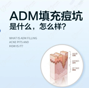 ADM填充