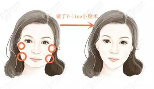 广州广大颧骨内推怎么样