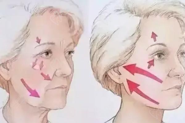 杨俊医生拉皮价格是多少