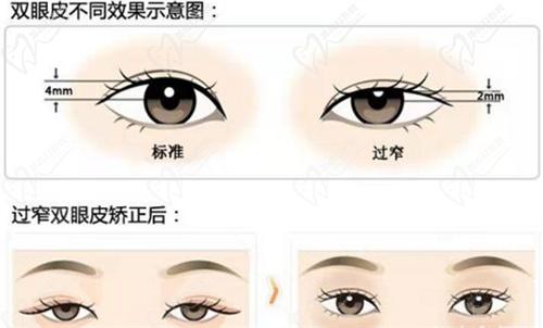 双眼皮过窄矫正.jpg