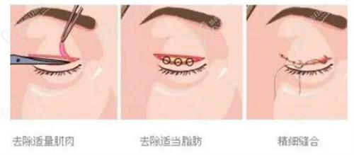 肿泡眼手术.jpg