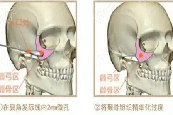 王东医生不开刀降颧骨的技术原理