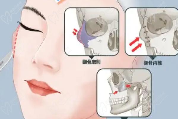 北京艺美王东降颧骨真实实例与求美者评价