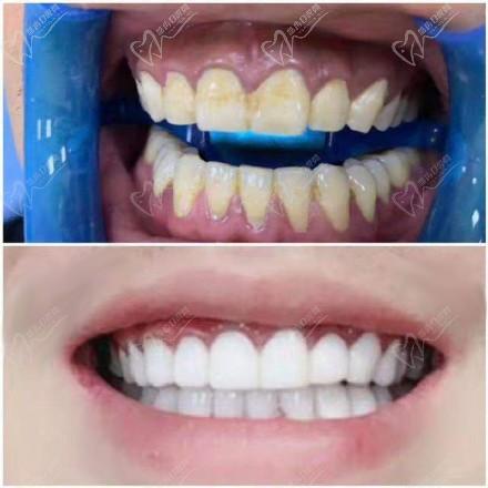 做牙贴面磨牙对牙齿的伤害大吗？能维持多久呢？