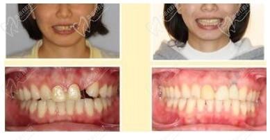 花12800元，找宁波拜博口腔林东杰做德系种植牙价格贵吗？