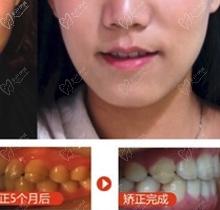 合肥美奥口腔正规吗?潘光东主任做隐形矫正才16800?是真的吗?