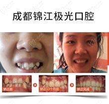 成都锦江极光口腔于海霞做牙齿矫正效果怎么样?价格贵不?