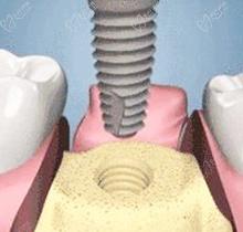 牙槽骨吸收了还可以种植牙吗?听九江中山口腔肖梁主任解说!