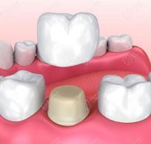 爱尔创和威兰德全瓷牙有什么区别?爱尔创价格1200是不是真的