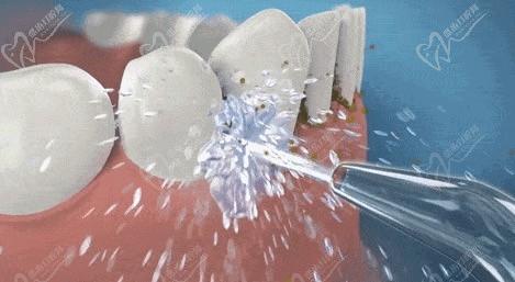 定期洗牙有必要吗？哪种情况下需要洁牙？洁牙的几大误区要了解！