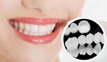 全瓷牙和烤瓷牙哪个好区别在哪?全瓷牙套多少钱一颗?2021价格表!