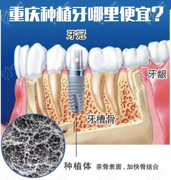 重庆牙卫士和牙博士哪家好？技术价格PK看哪家种植牙更便宜？