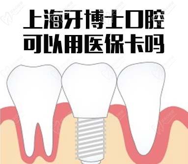 上海牙博士口腔可以用医保卡吗？来了解牙博士口腔种植牙价格表（2021版）
