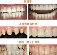 牙齿修复有哪几种方法?牙齿缺失用哪种比较好?价格多少?