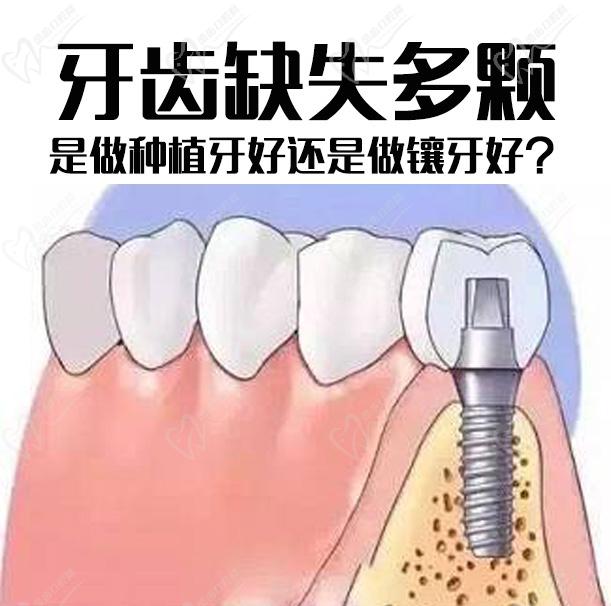 贵阳德韩口腔张金科院长解答:牙齿缺失多颗,是做种植牙好还是做镶牙好？