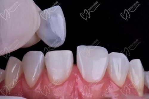 我做牙齿贴面5年后感受！奉劝大家千万别做树脂牙齿贴面！