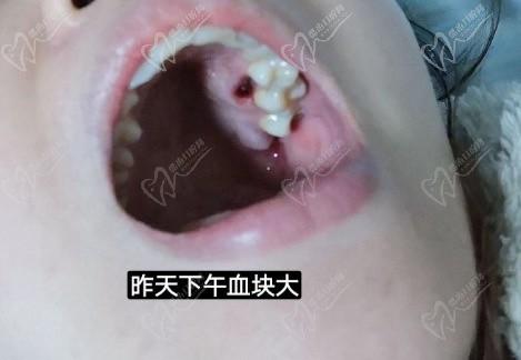 拔牙5天后牙窝愈合过程图,经过多长时间才能完全愈合呢?