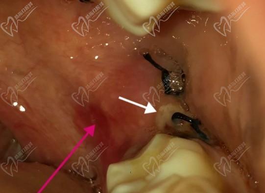 拔智齿后洞恢复过程14天图解，看拔智齿后牙洞需要多久能长好！