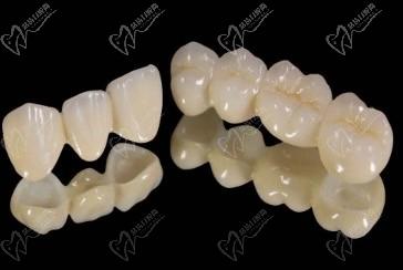 800元一颗的全瓷牙好吗？全瓷牙价格一般是多少钱？