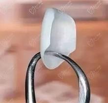 美加牙贴面和冰瓷牙贴面哪个好？做超薄美加牙贴面一般需要多少钱？