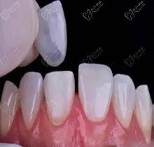 美牙科普丨纳米树脂牙齿贴面和瓷贴面区别的颜色对比图照片