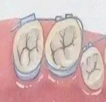 武汉清华阳光口腔医院怎么样?高性价比金属托槽矫正靠谱吗?