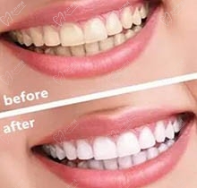 牙医说不要做冷光美白，是因为对牙齿有什么伤害吗？