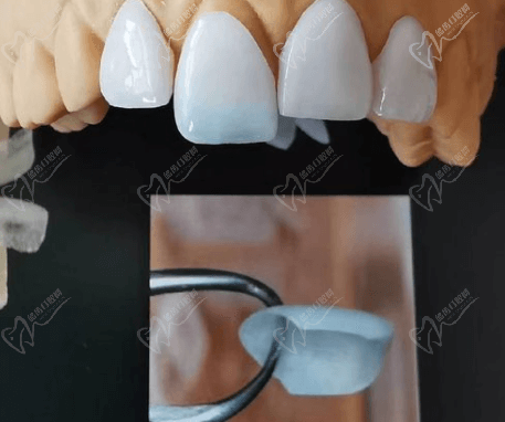 请问牙贴面有什么后遗症吗？大概要多少钱一颗呢？