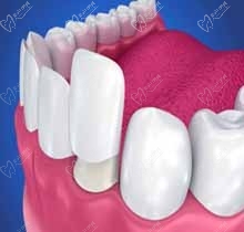 想问义获嘉emax铸瓷贴面好不好？有做牙齿贴面后悔的吗？