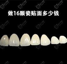 做16颗瓷贴面多少钱？亲身经历回答全瓷贴面对牙齿伤害大吗