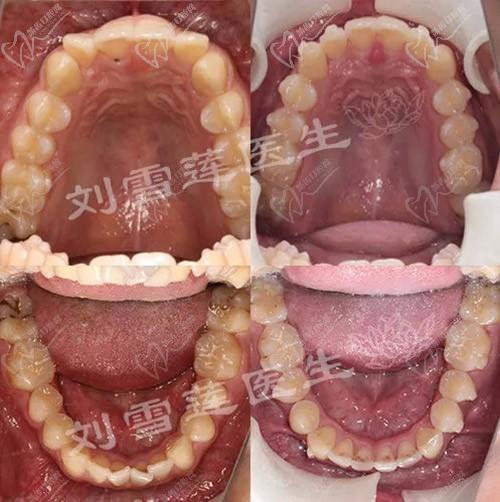 北京圣贝口腔刘雪莲正畸怎么样？她龅牙矫正的技术很出名吗？