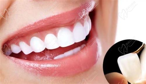 全瓷贴面是全瓷牙吗？分析两者之间的差别在哪
