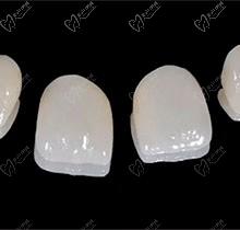 要是门牙做瓷贴面会烂牙吗？很好奇牙齿贴面10年后怎么办