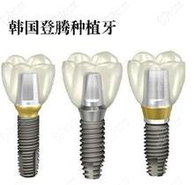 宁夏银川诺贝尔口腔韩国登腾种植牙套餐3999元起，性价比超高看过来