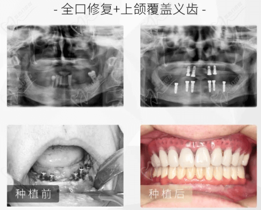 重庆当代口腔肖林做种植牙怎么样?半口全口修复都能做技术准没错!