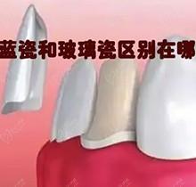 蓝瓷牙贴面多少钱一颗？蓝瓷是什么材质来看蓝瓷和玻璃瓷区别