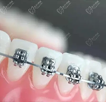 深圳麦芽口腔吴伯海怎么样？牙齿矫正技术靠谱不来看真实评价