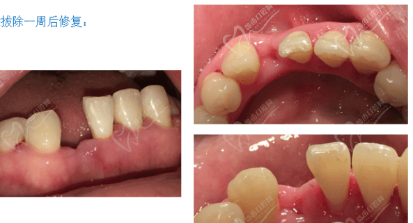 武汉清华阳光口腔石国龙医生技术如何？做牙齿修复怎么样？