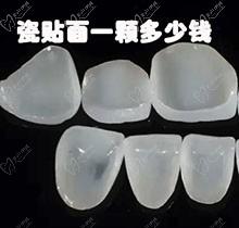 氟斑牙做瓷贴面一颗多少钱？改善氟斑牙做瓷贴面能维持多久
