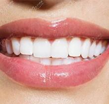 仿生复合瓷贴面好吗？来展开讲讲它的优缺点都有哪些