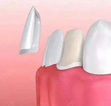 水晶瓷牙贴面和玻璃瓷哪个好？对比二者区别和价格全知晓