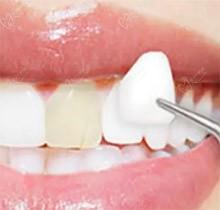 ​揭秘超模瓷贴面和全瓷贴面区别，做牙贴面哪个好都能保持多久？