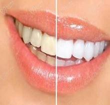 我做了牙齿贴面非常后悔，亲身讲述自己做牙齿贴面步骤全过程