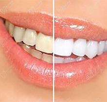 美佳牙齿贴面好不好？想知道长期做牙齿贴面有什么危害吗？