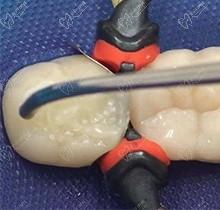 补牙玻璃离子好还是树脂好？想问3m树脂补牙算300贵吗