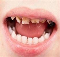 9岁小孩门牙摔断了还能长出来吗？牙磕掉了一半怎么修复比较好？