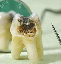 牙髓炎拔牙能解决吗？如果说牙髓炎拖几个月会恶化吗