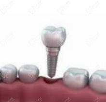 扬州金铂利口腔医院技术怎么样?做种植牙和牙齿矫正靠谱又美观