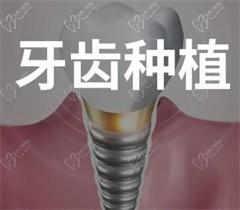 佛山鼎植口腔门诊怎么样,经价格表查询种植牙矫正牙齿真不贵！