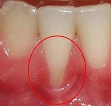 分享牙周根面覆盖术价格和手术步骤，原来牙龈退缩是有救的！
